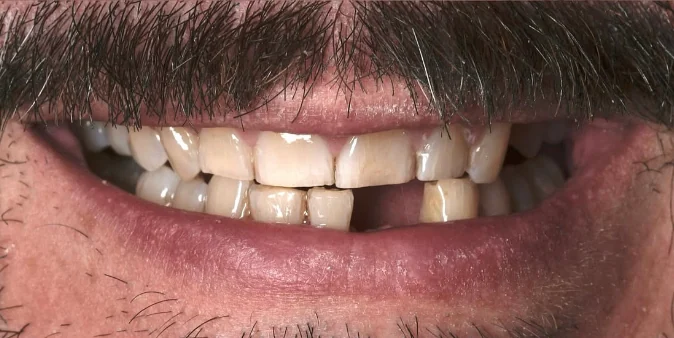 Close-up of a man's mouth with a mustache showing uneven, chipped, and discolored teeth with a missing front tooth.