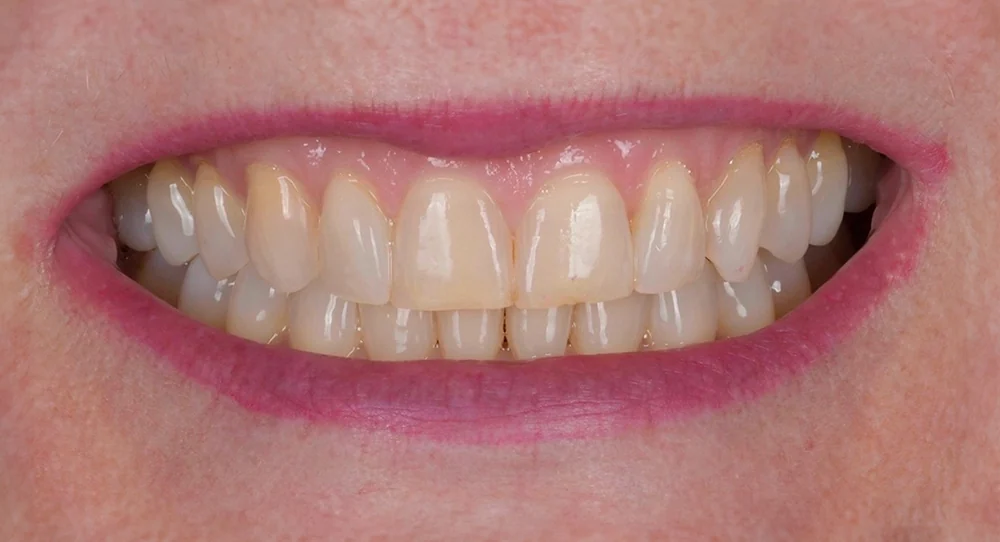 Smile 2 before treatment