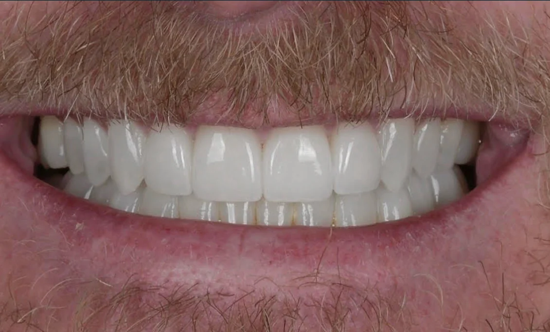 Close-up of a mouth with a mustache showing clean white teeth and smile.