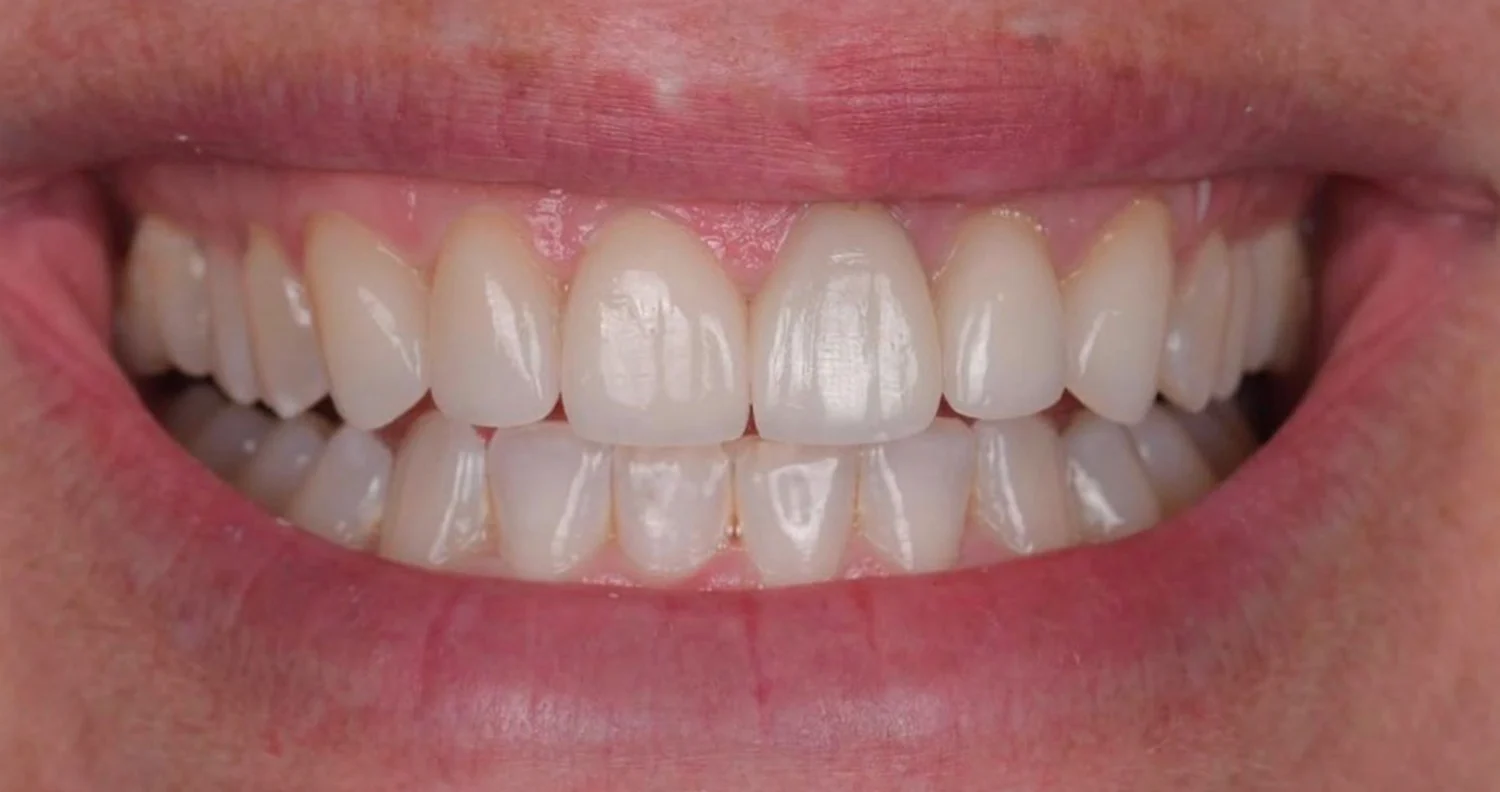 Close-up of a smile showing clean, well-aligned upper and lower teeth with healthy gums.