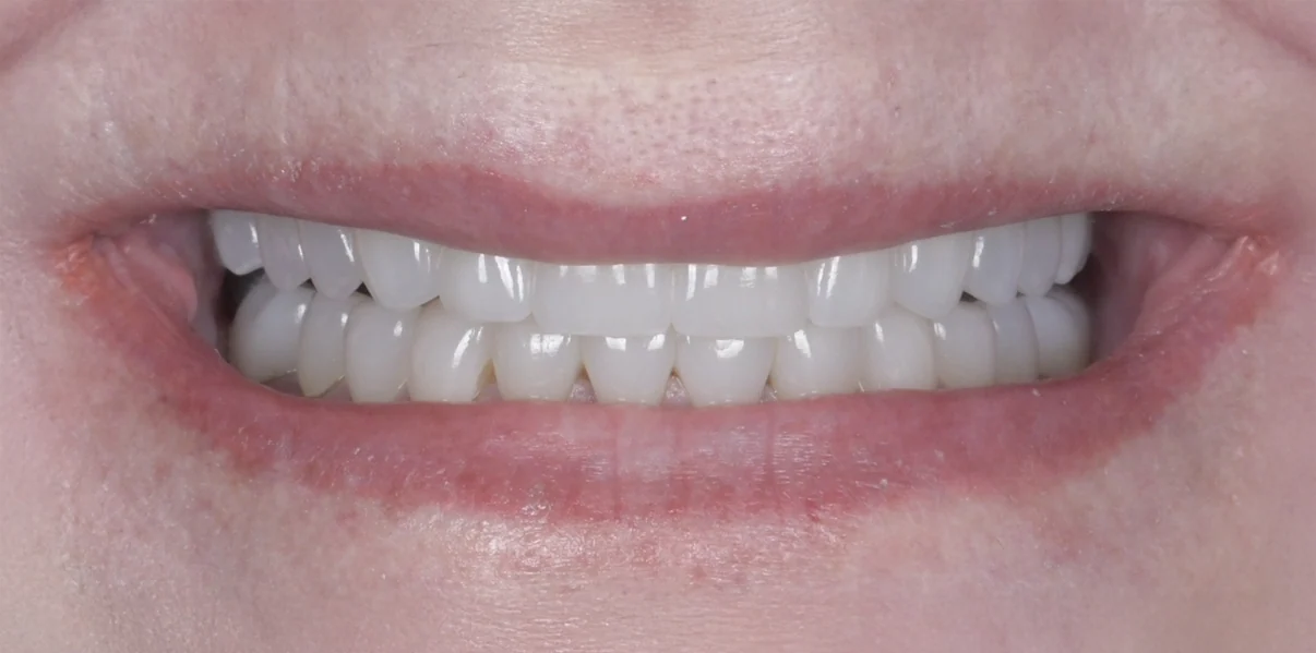 Close-up of a person's mouth showing white, straight teeth with lips slightly parted.