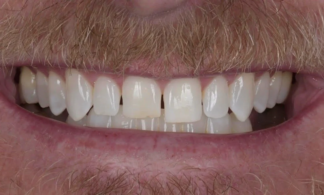 Close-up of a man's smile showing white teeth and a blond mustache and beard hairs.