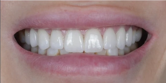 Close-up of a person's smile showing straight, white teeth and light pink lips.