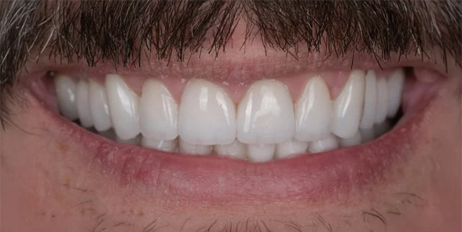Close-up of a person's mouth smiling, showing clean and white upper teeth with a mustache above the lips.