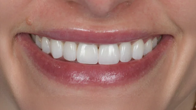 Smile 1 after treatment