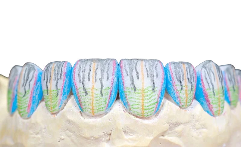 Dental model showing eight front teeth marked with colorful lines indicating enamel and dentin layers.