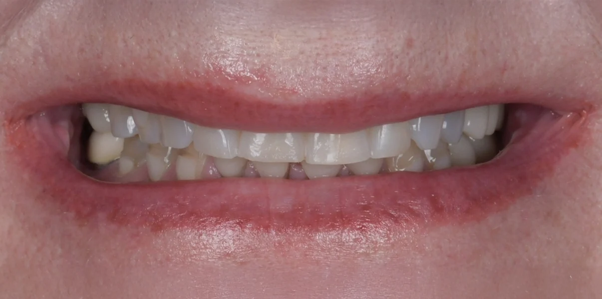 Close-up of a partially smiling mouth showing uneven, slightly stained upper and lower teeth.