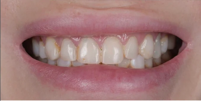 Close-up of a person's mouth smiling, showing teeth with visible plaque and discoloration.