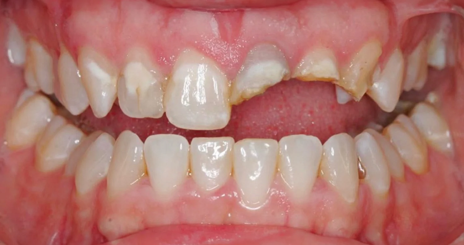 Close-up of a mouth with chipped, discolored upper front teeth and healthy lower teeth visible.