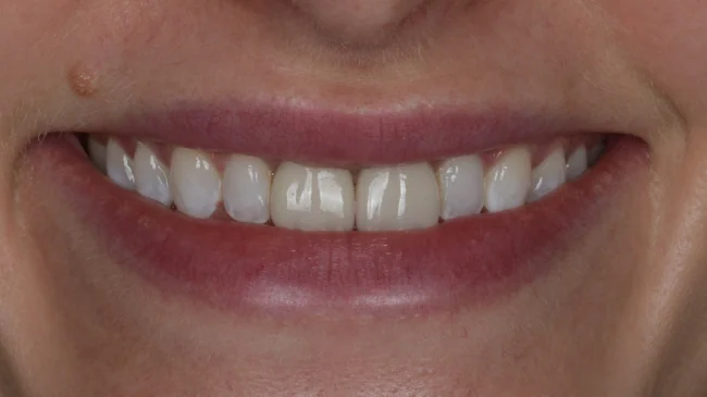 Smile 1 before treatment