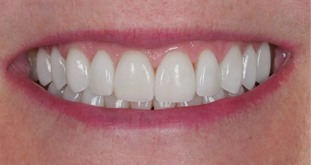 Smile 2 after treatment